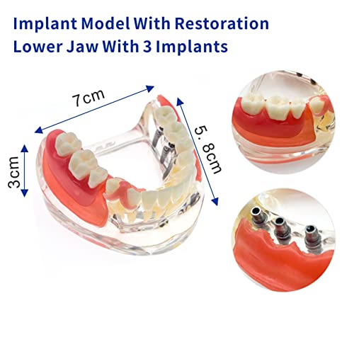 Възстановяване на зъбни импланти Typodont Модел на зъбите M6006 Overdenture 3 Импланта Мостовидный Протеза на Долна Демонстрация