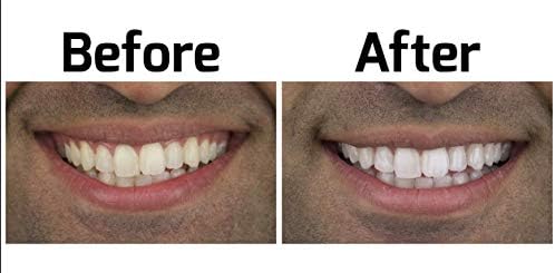 Комплект за избелване на зъби с опалесценцией. Най-добър избелващ продукт за по-бели зъби. Удобни тави Opalescence Go Остане на мястото си по-Добре, отколкото избелващи ле?