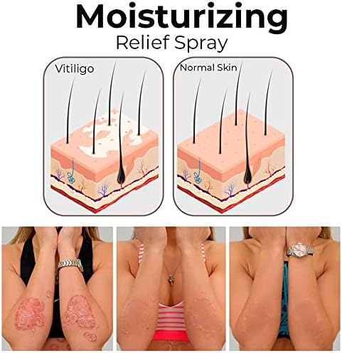 LAVUCE Спрей за облекчаване на витилиго, Крем за грижа за кожата, при витилиго, регулиране на пигментацията и който подобрява