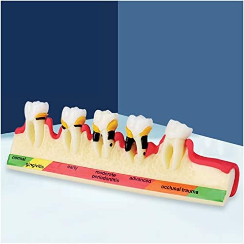 Модел на Класификация на пародонталните заболявания KH66ZKY, Демонстрационен Модел на зъбите, Модел дисплей за