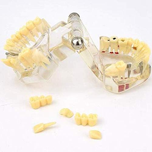 Реставрация на зъбите, Импланти Патологична Модел Ясна Демонстрация на Модели на Заболявания на Зъбите Демонтаж на